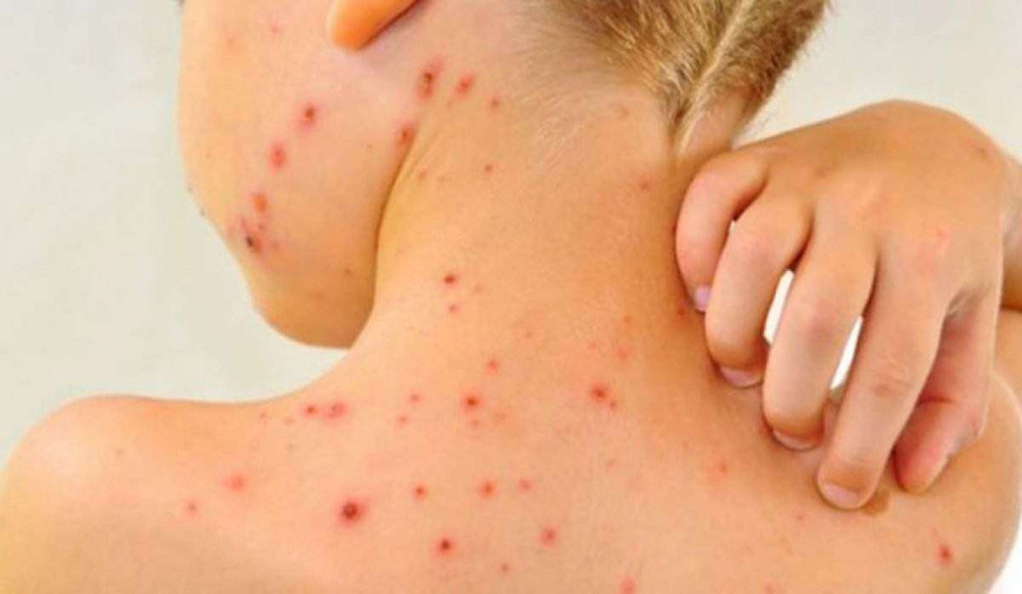 Measles Cases Surge in 2025: US Reports Higher Numbers in First Three Months Than Entire Previous Year