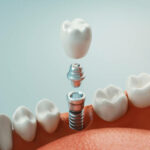 Implantul dentar: De ce ar trebui să-l iei în considerare pentru zâmbetul tău