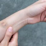 Vânătăile ce apar din senin, semnal de alarmă – Alte simptome ale lipsei de vitamine K și C