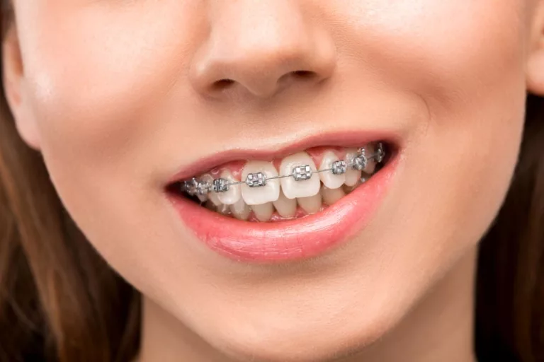 Ghidul tău despre aparatul dentar – TOT ce trebuie să știi