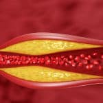 Boala coronariană: cauze, simptome și opțiuni de tratament