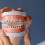 Cum să alegi un aparat dentar potrivit problemelor tale? 3 sfaturi utile